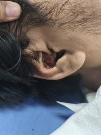 Some ear bleed, turned out to be nothing